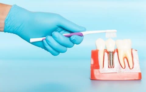 Dental Implants Aftercare: Post Implant Care Instructions