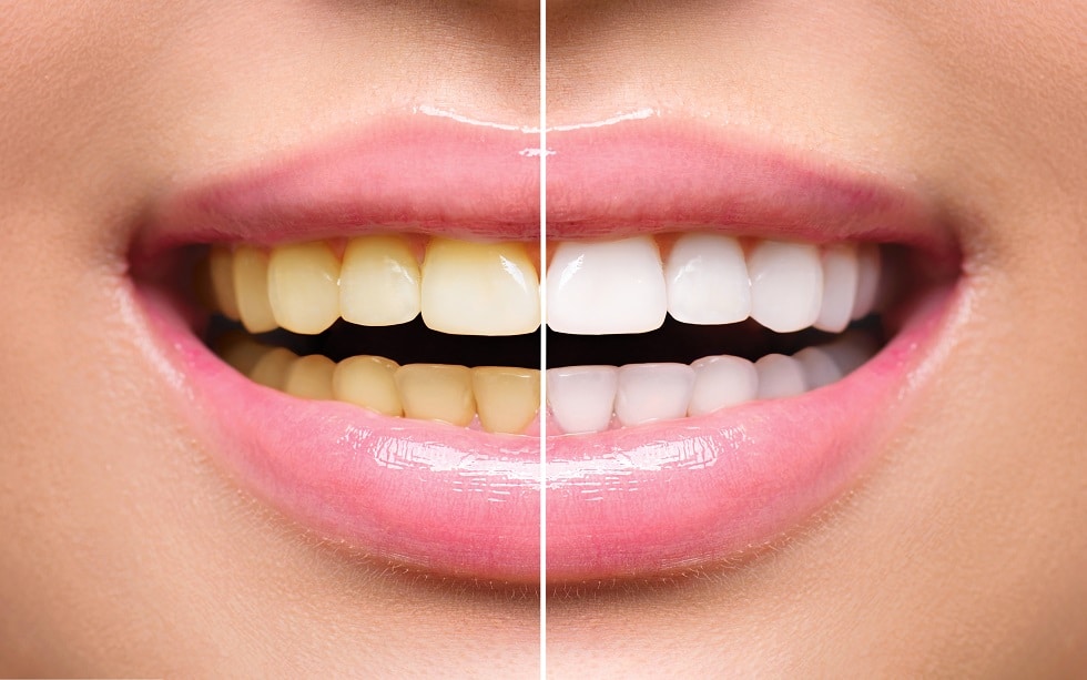 Woman teeth before and after whitening