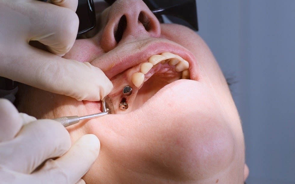 Senior woman getting dental implants